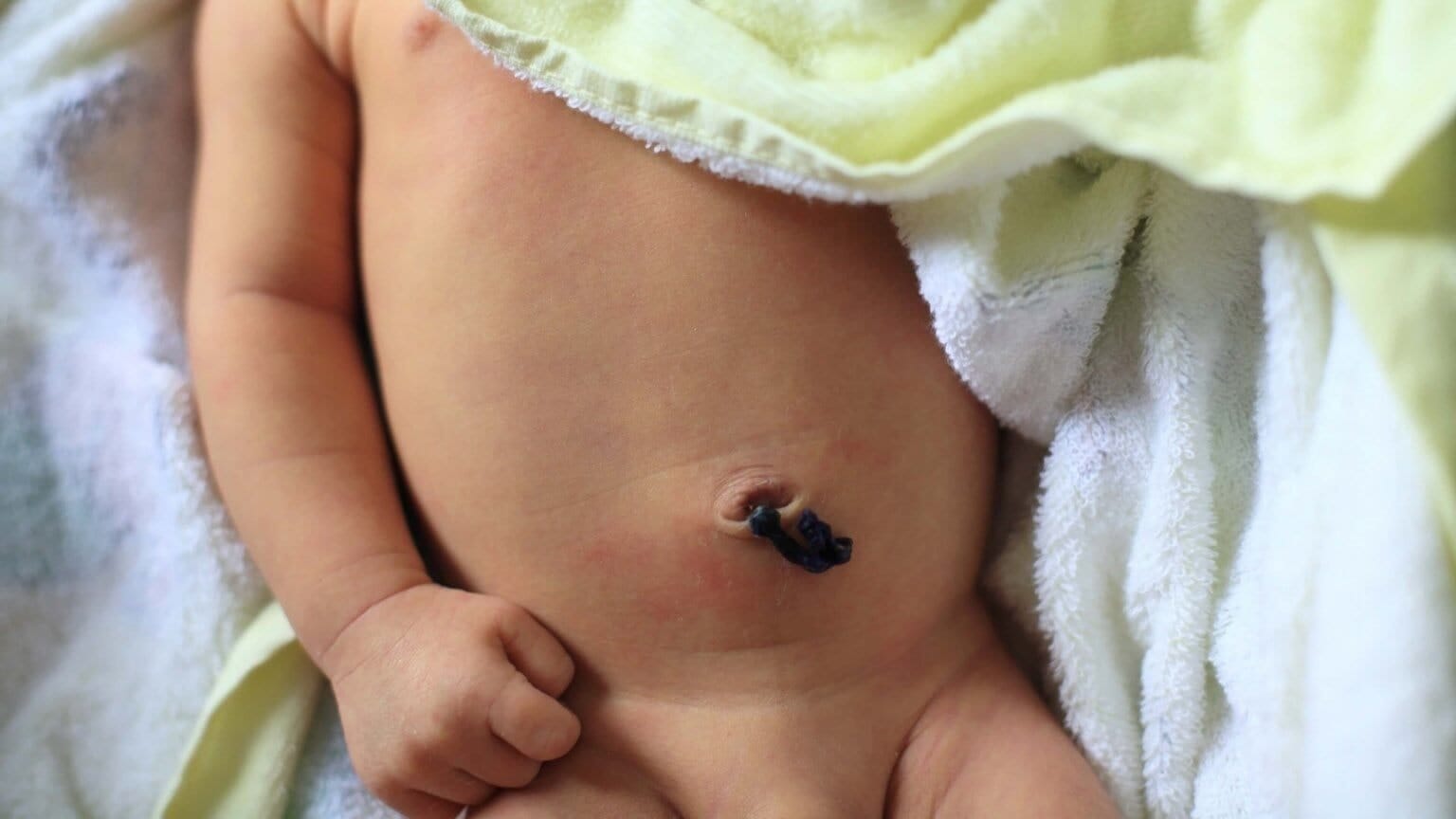baby's umbilical cord stump
